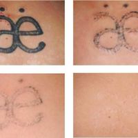 freaktattooremove
