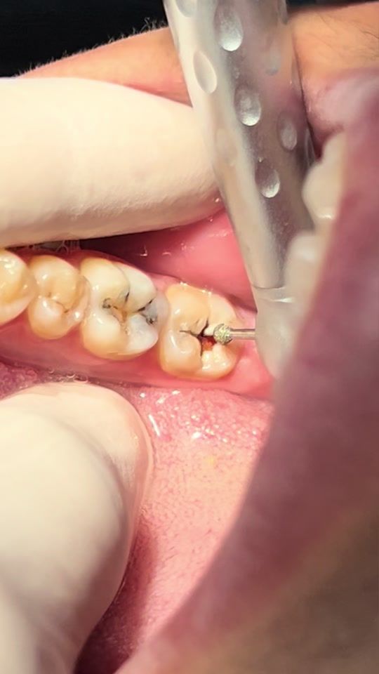 TikTok video thumbnail by dr.morad.shaglouf