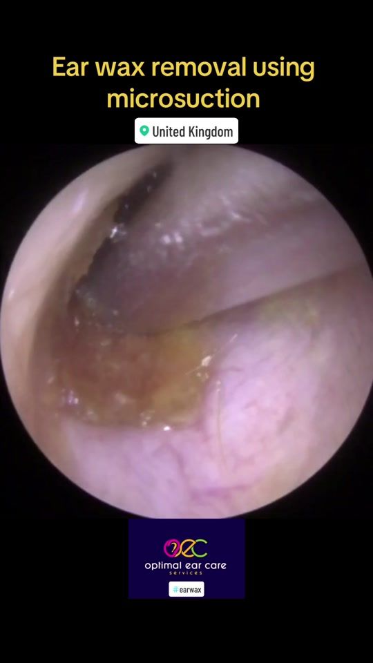 TikTok video thumbnail by optimalearcareservices