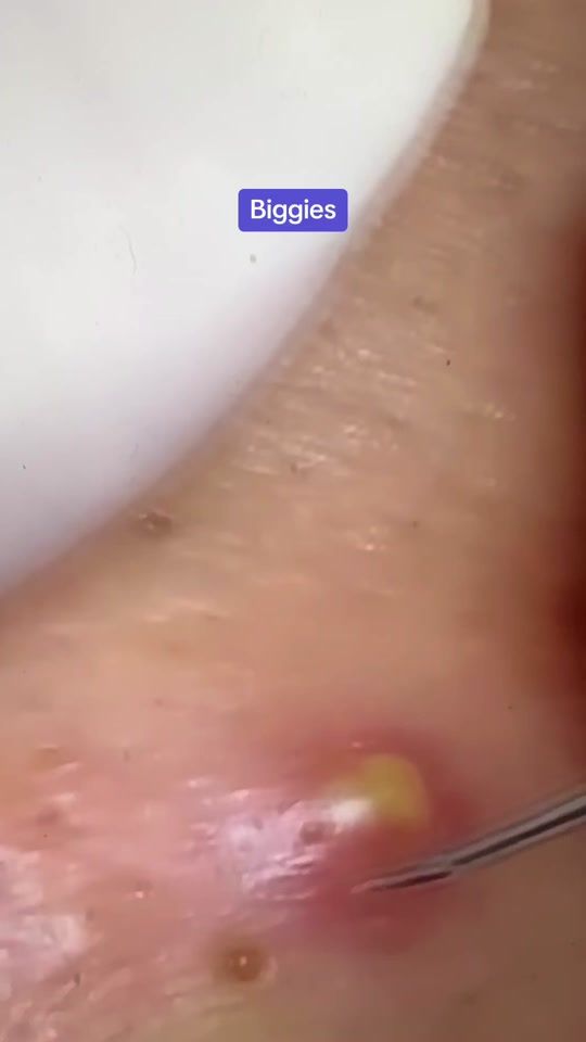 TikTok video thumbnail by pimplesgalore0