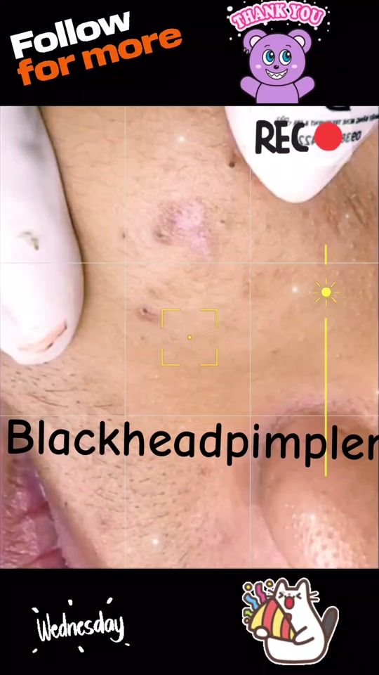 TikTok video thumbnail by blackheadpimpler