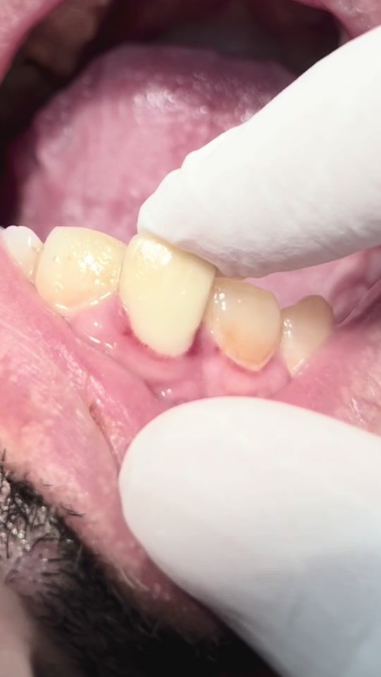TikTok video thumbnail by dr.morad.shaglouf