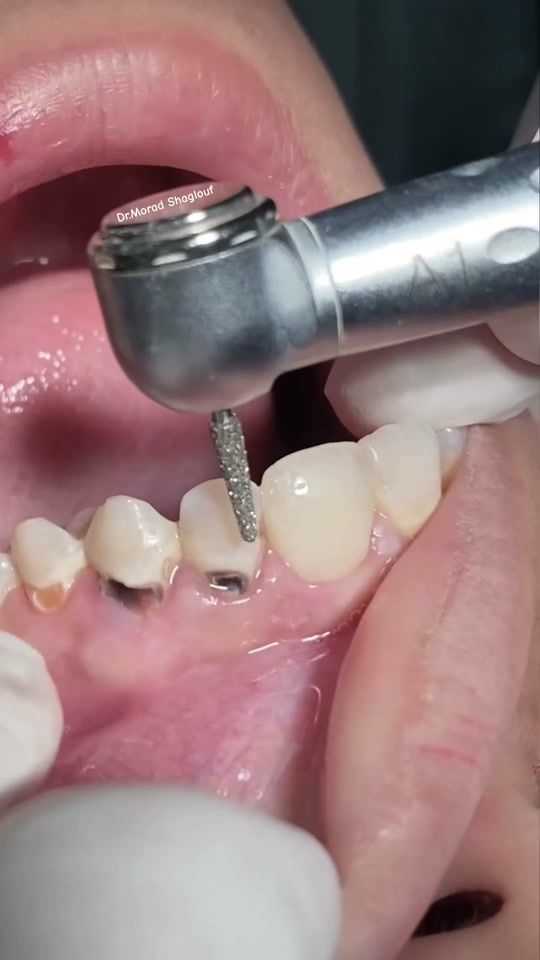 TikTok video thumbnail by dr.morad.shaglouf