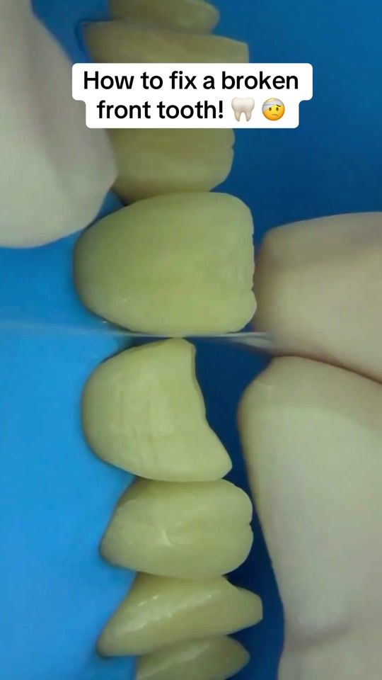 TikTok video thumbnail by suttondental_skynology